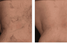 Spider Veins: Can They Go Away on Their Own  Vein Center in Walnut Creek,  Brentwood, and Oakland