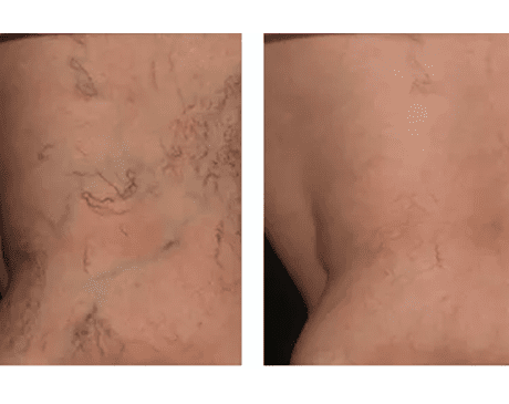 Spider Veins: Can They Go Away on Their Own  Vein Center in Walnut Creek,  Brentwood, and Oakland